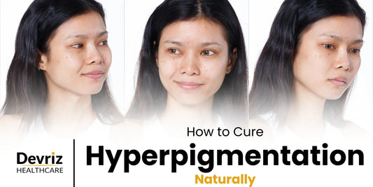 Hyperpigmentation