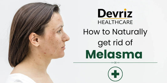 Rid of Melasma