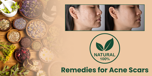 Natural remedies for acne scars