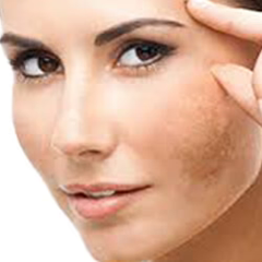 Hyperpigmentation