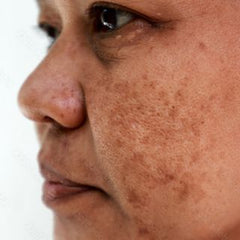 Melasma Skin