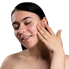 Acne Care