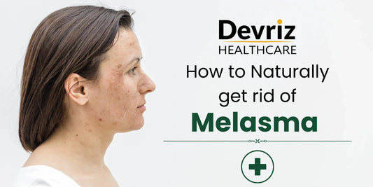 rid of melasma