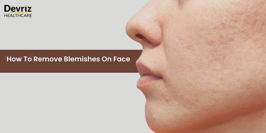 How to Remove Blemishes on face