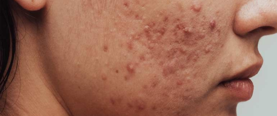 Acne