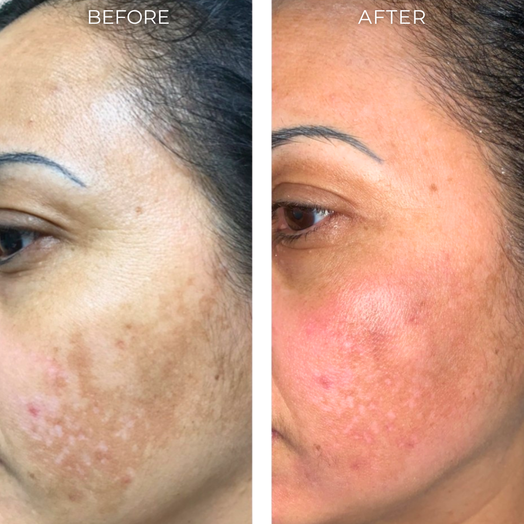 Hyperpigmentation