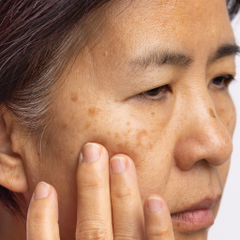 Melasma Skin