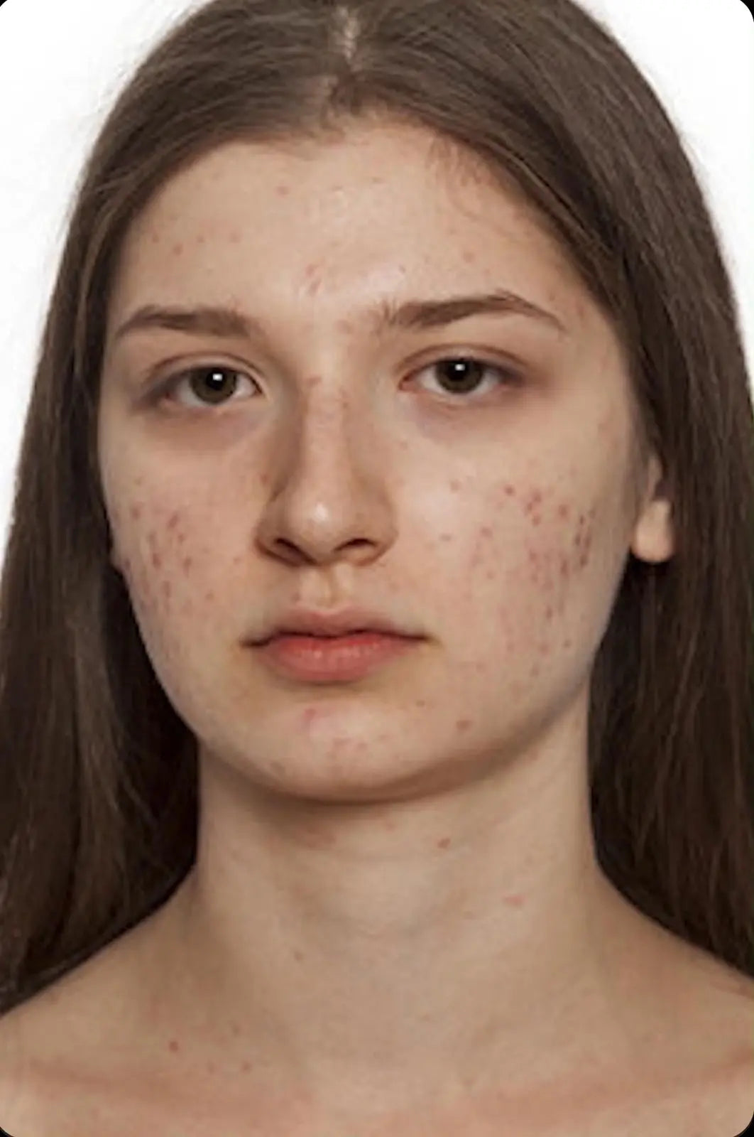 Acne and Pimple Kit Devriz Healthcare