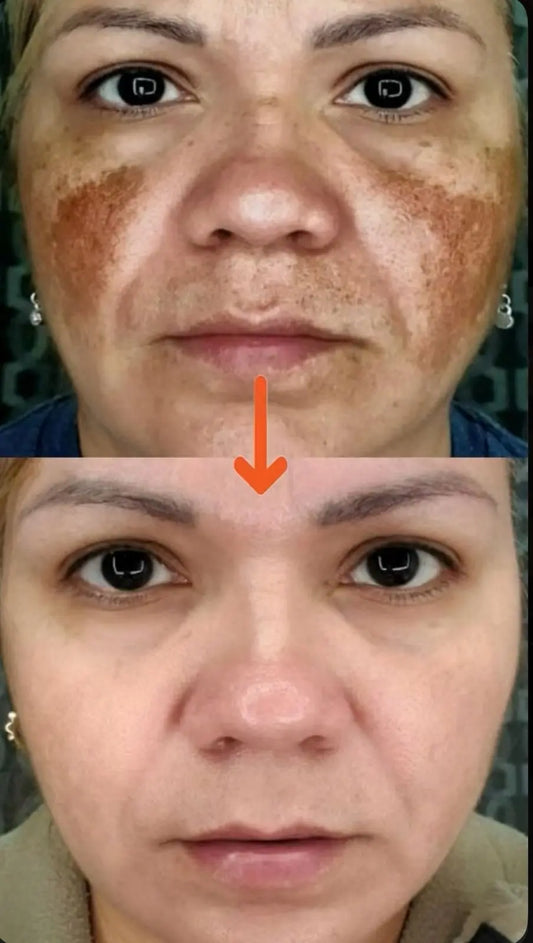 hyperpigmentation Treatment Kit Devriz Healthcare